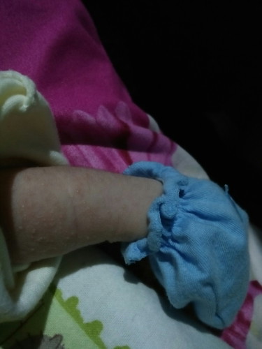 bintik2 di tangan anak