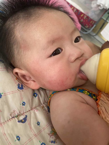 ผื่นแดงเตมหน้าเตมตัว