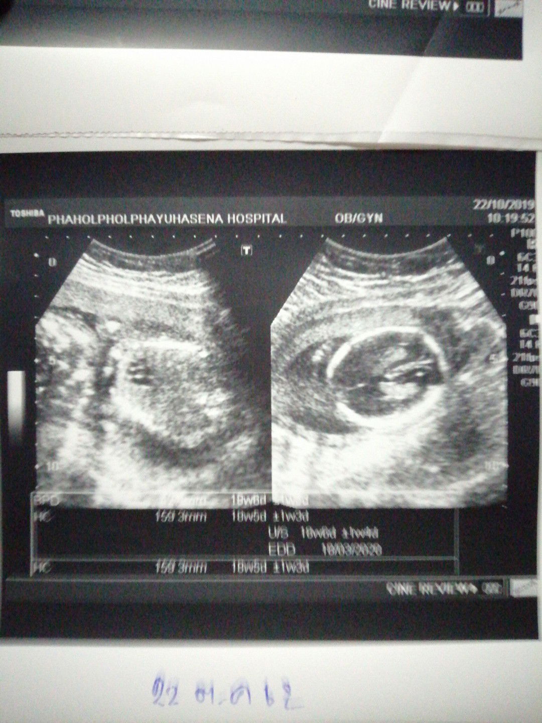 สอบถาม​เรื่อง​รูป​อัลต้าซาวด์หน่อยค่ะ