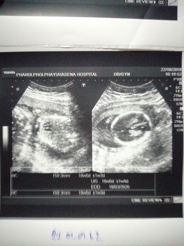 สอบถามเรื่องรูปอัลต้าซาวด์หน่อยค่ะ