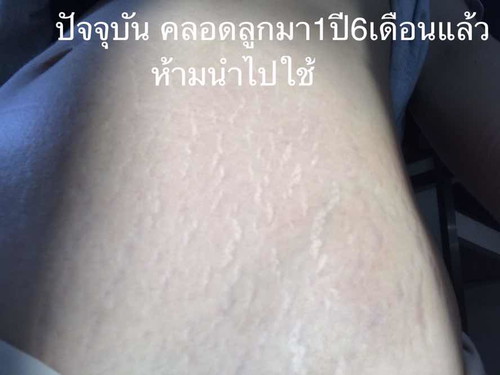 ปัญหาหน้าท้องแตกลายจากการตั้งครรภ์
