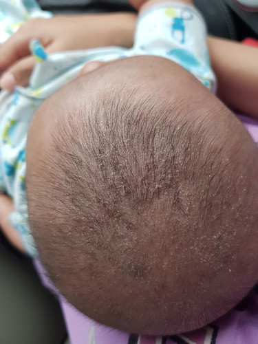 kulit kepala bayi