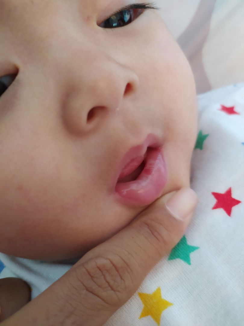 bercak putih di mulut