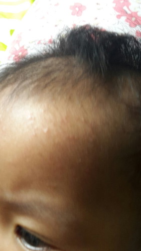 allergy