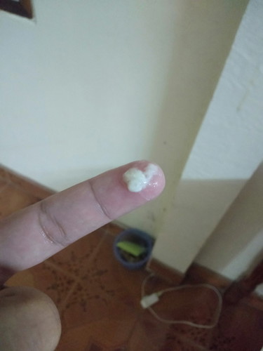 อายุครรภ์ 32+2