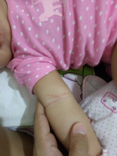 Rashes