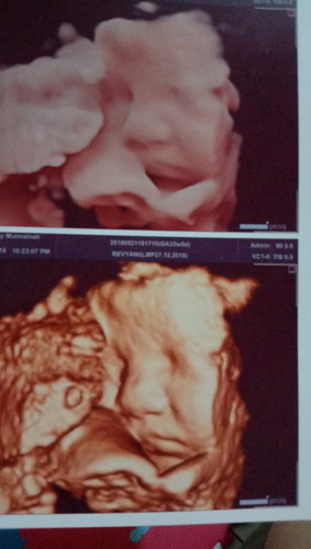 usia kehamilan 34 week
