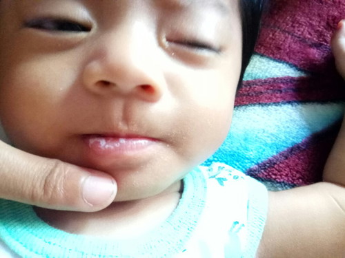 bercak putih didinding mulut dalam