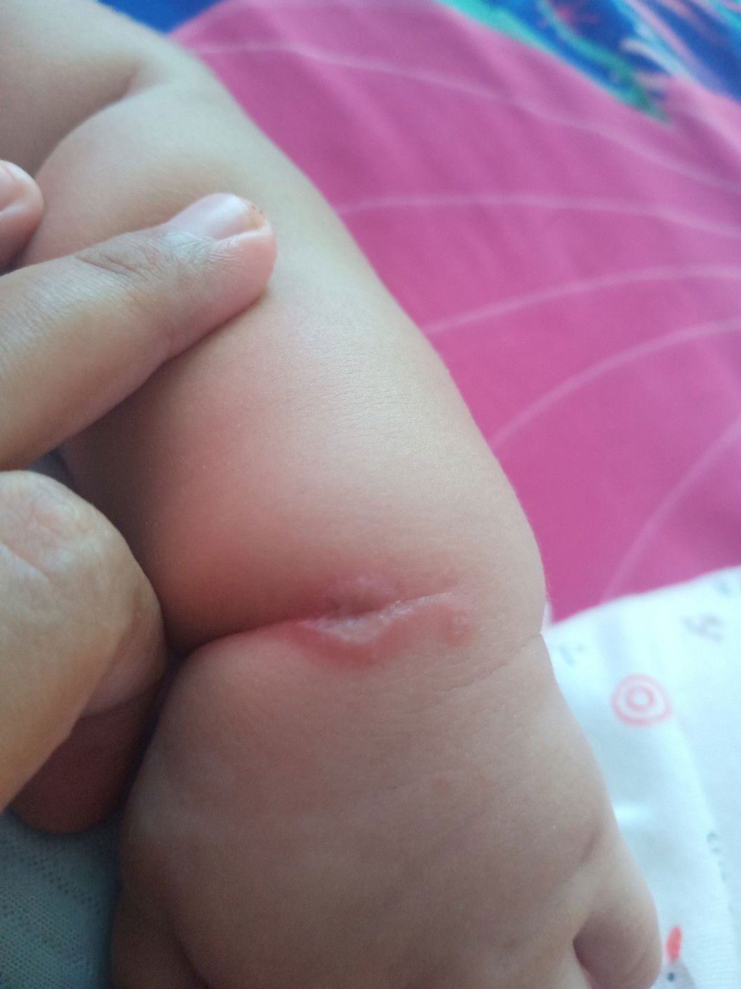 Ini cacar atau bukan