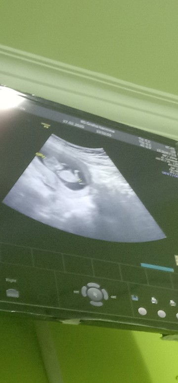 usg 11 Minggu udah ad detak jantung ny dan sehat