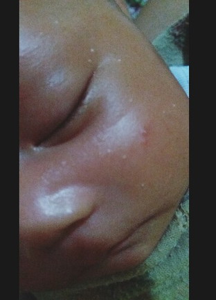 bintik2 putih diwajah bayi
