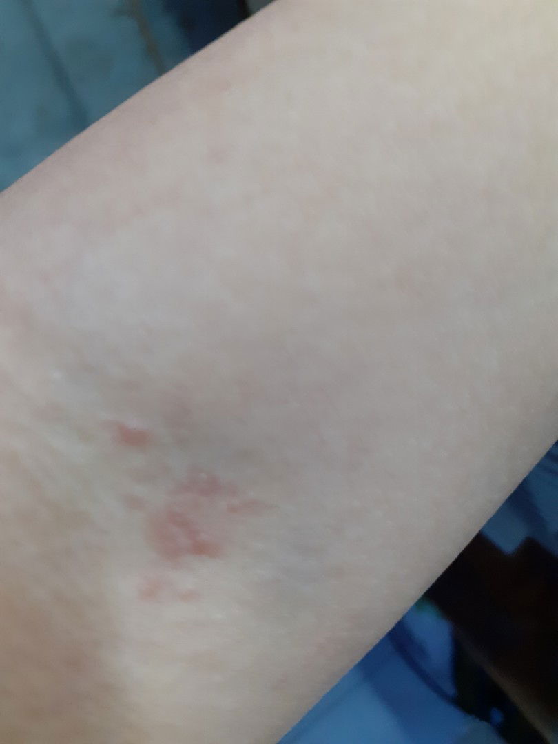 Bentol dan gatal2 tiba2 (sebelum hamil ga pernah)