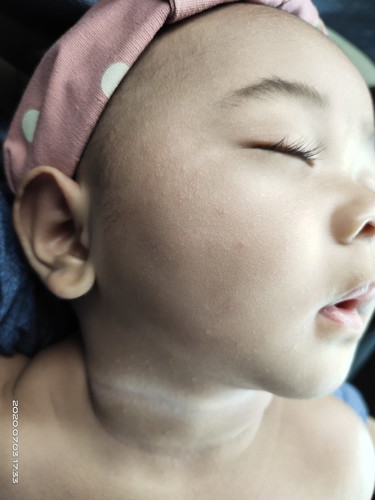 kulit sensitif