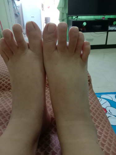 อาการท้องบวมใช่ไหมค่ะ