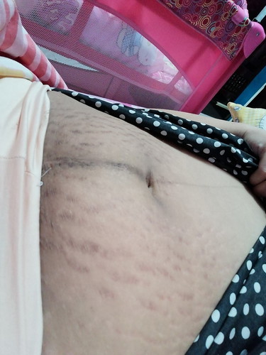 Stretch Marks