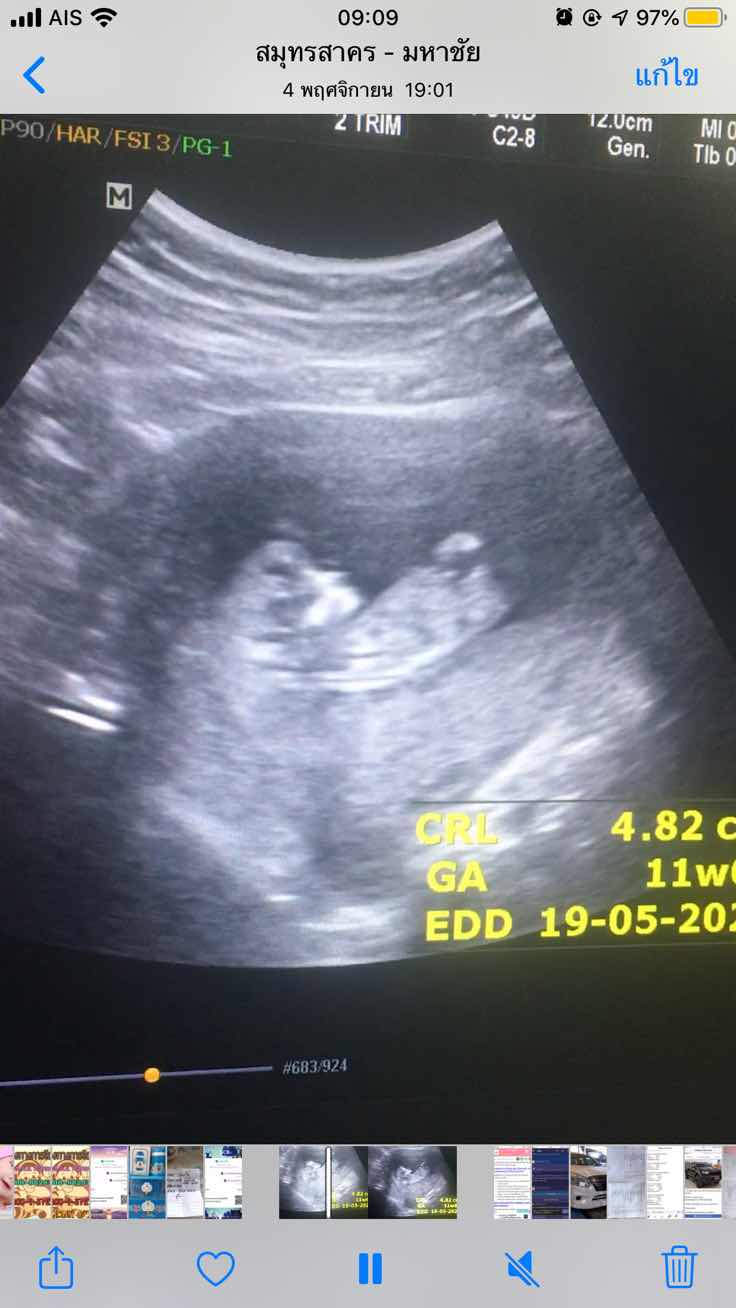 บ้านไหนคัยรุ้บ้าง???ช่วยบอกที!!!…คือตอนนี้ที่นับท้องคือเราท้องได้4เดือน (แต่ตอนเดือนแรกเราตกเลือด เราก้อไม่รุ้ว่าหลุดรึไม่หลุด) แต่พอเราไปฝากท้องหมอบอกว่า เราท้องได้2เดือนกว่า แต่ผลอัลตร้าซาว