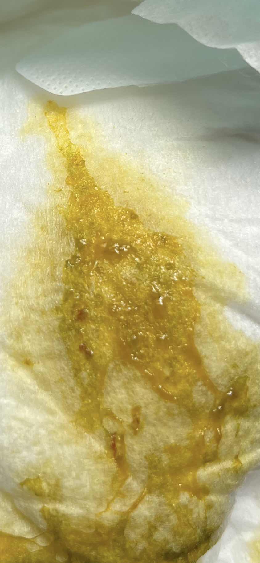 น้องถ่ายมีเส้นเลือดฝอยๆ