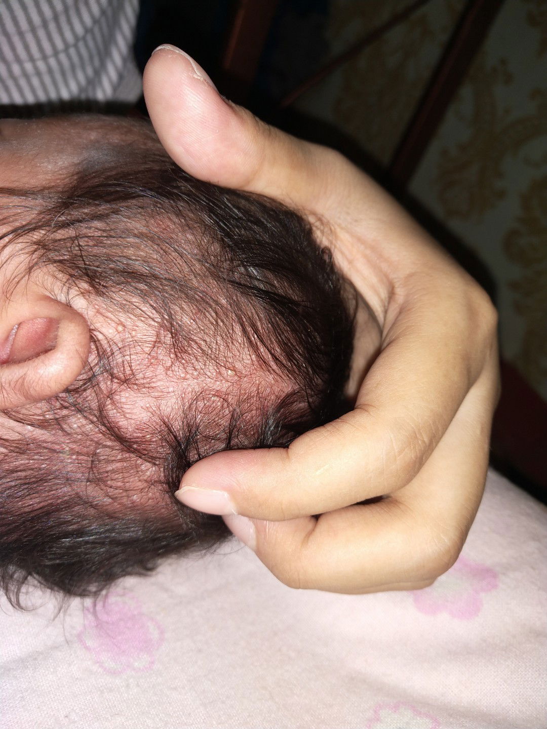 bintik Ijo/ nanah di kepala