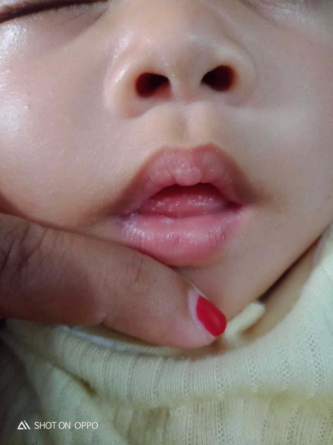 bercak putih di lidah dan bibir