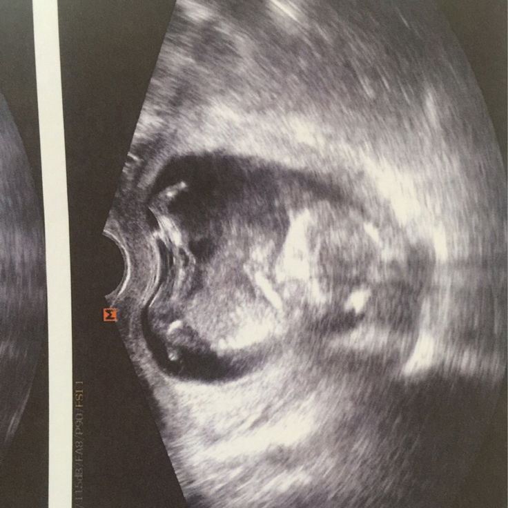 เล่าสู่กันฟังนะคะสำหรับคุณแม่ท้องอ่อนๆ