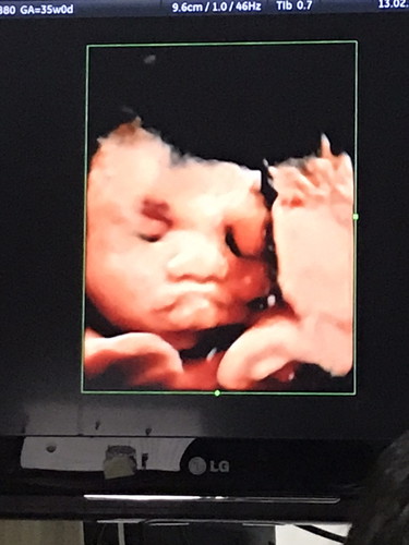35week+2แล้วจ้า?