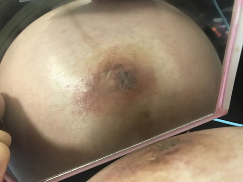 ใครสะดือจุ่น ท้องแล้ว เป็นแบบนี้กันไหมคะ อาจจะดูน่ากลัว