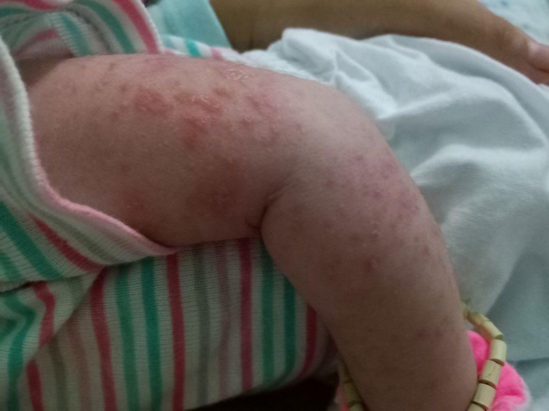 các mom cho e hỏi bé bị lên mụn này có sao ko ạ?