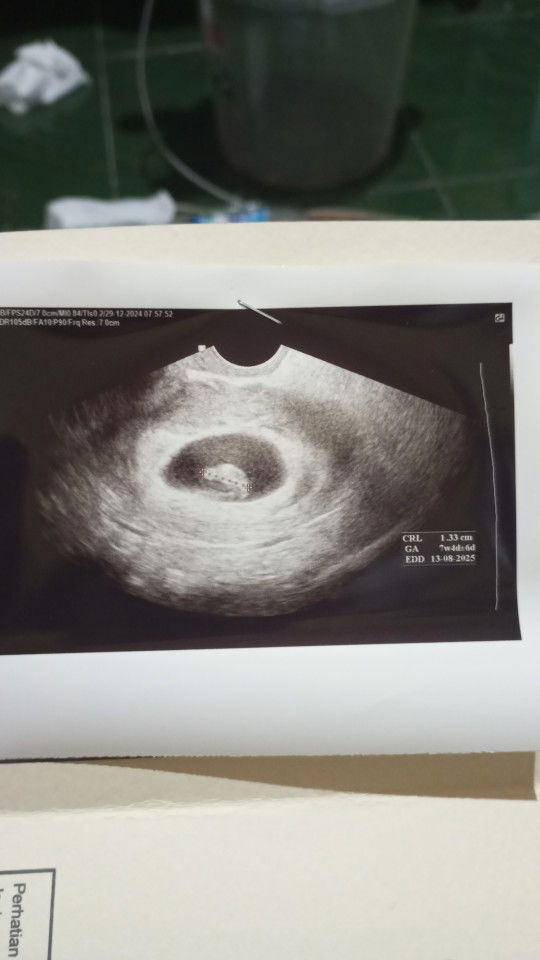 Usia kehamilan 7 minggu