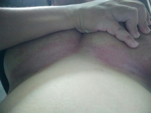 ท้องได้24สัปดาห์คันบริเวณใต้ราวนม..ขออภัยหากภาพไม่เหมาะสม