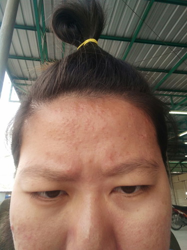 สบู่ล้างหน้าหรือเป็นเพราะฮอร์โมน