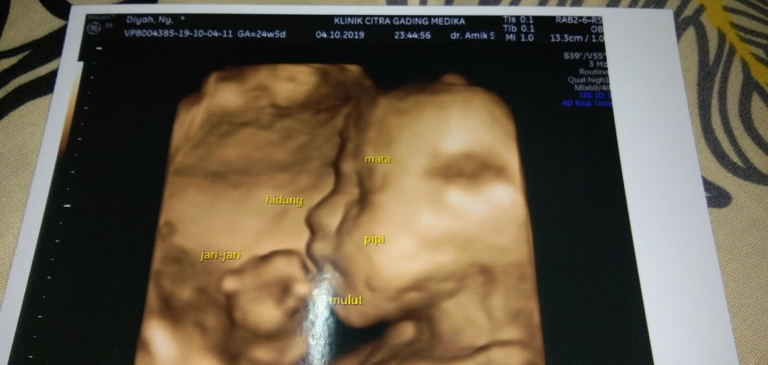 Tips Agar Usg Bs Kelihatan Foto Bayi Dr Depan