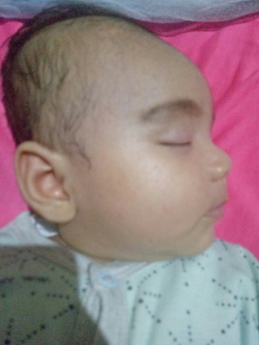 kepala bayi bulat