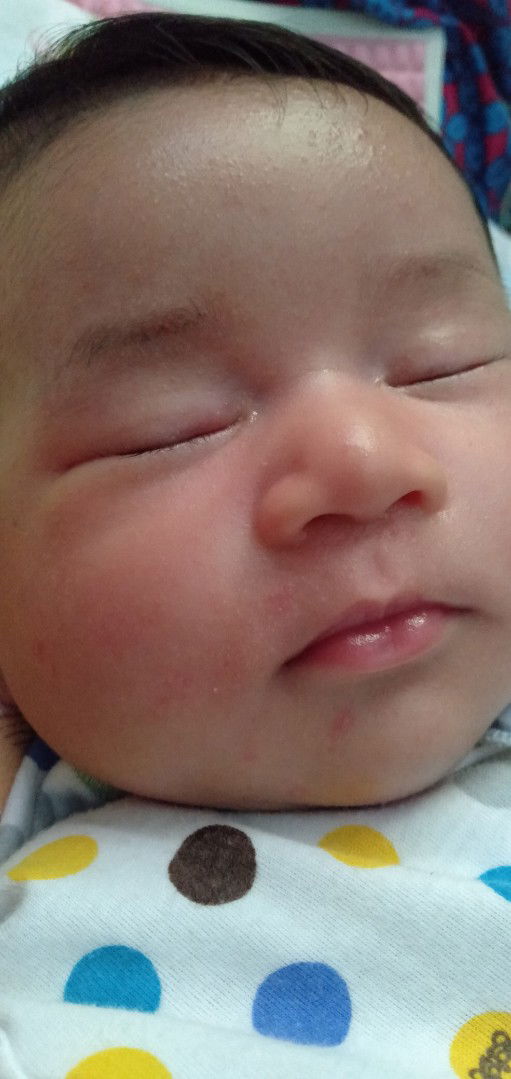 bintik bintik kecil dan merah dimuka