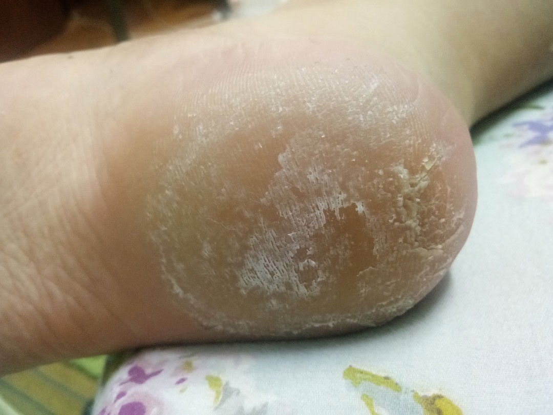 tapak kaki menggelupas