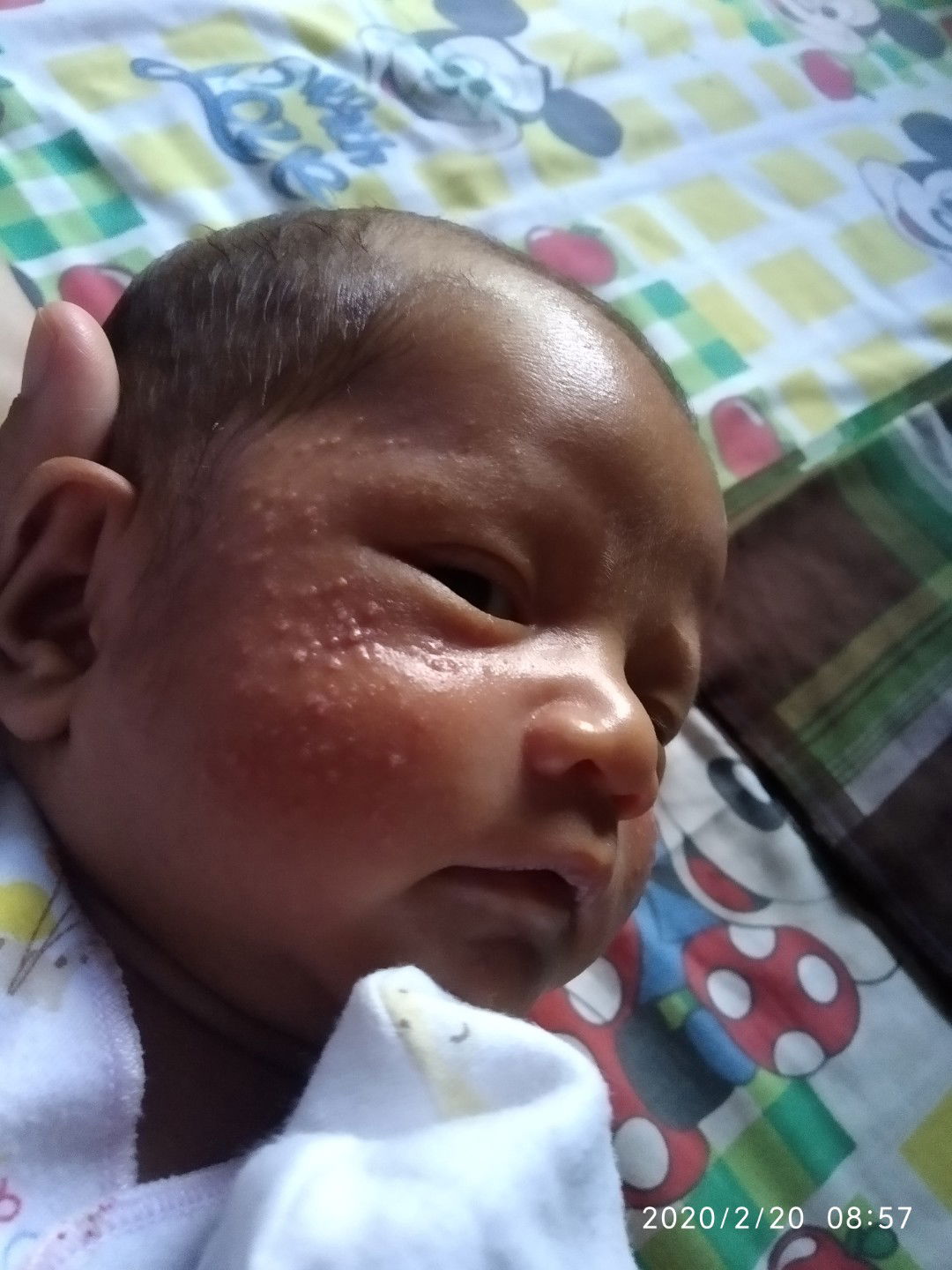 muka baby 20 hari bintik bintik merah nanah