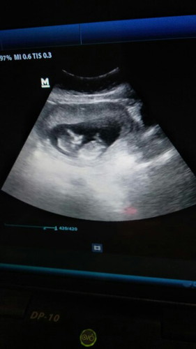 13 week