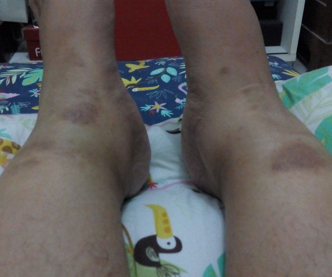 Bekas Gatal Menghitam