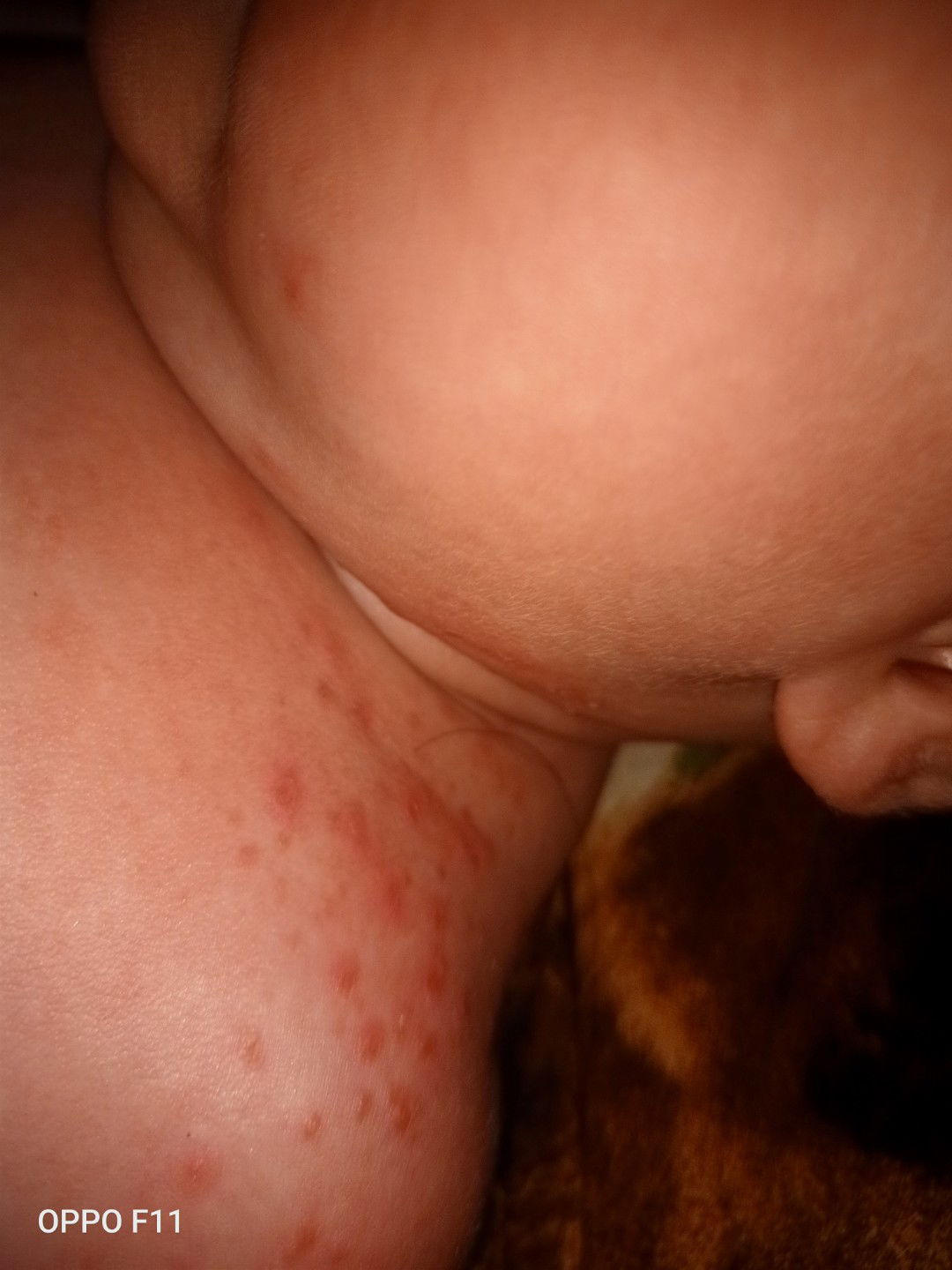 kulit bayi 4 bulan melenting berair ujungnya