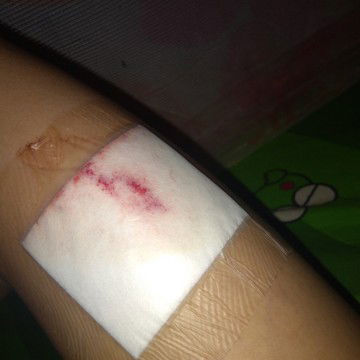 tanya tentang KB inplan/KB susuk