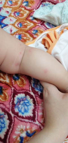 Ruam Dan Bintik Pada Kulit Bayi