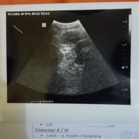 hasil usg ?