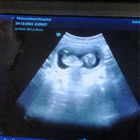 ขอสอบถามแม่ๆค่ะแบบนี้น้องแข็งแรงปลอดภัยใช่มั้ยคะพอดีโดนคนเมา
ยาเอาไม้มาตีท้อง+คุณแม่มือใหม่ค่ะ+ ไม่ชาวตอน9w ค่ะ