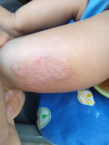 แม่ๆๆบ้านใหนลูกเป็นแบบนี้บางและใช้ยาอะไรดี