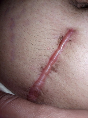 Low vertical incision
