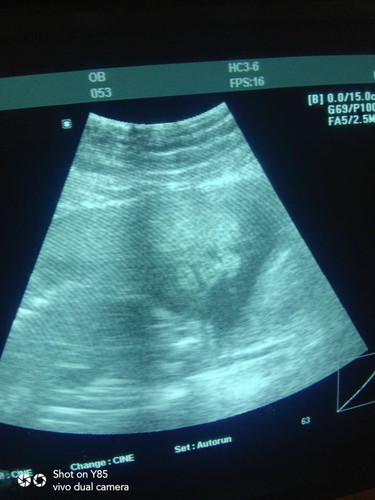 Ultrasound