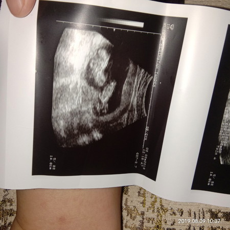 terharu dapat baby twin..