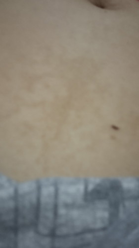 Skin patches