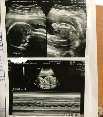 ultrasound