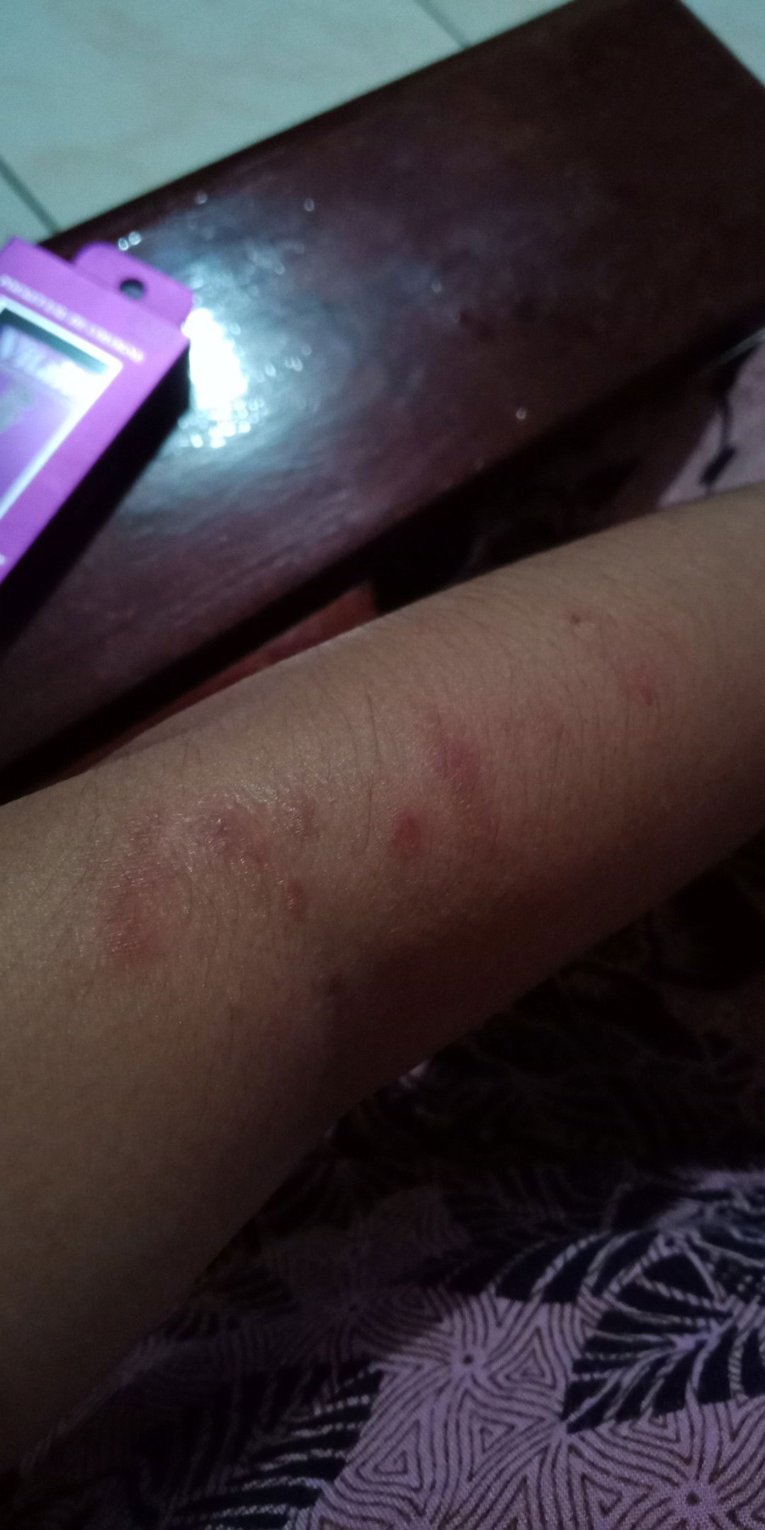 cara mengurangi/menghilangkan gatal