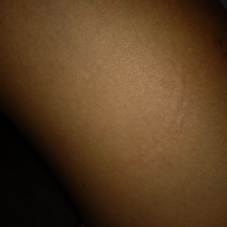 Allergy???